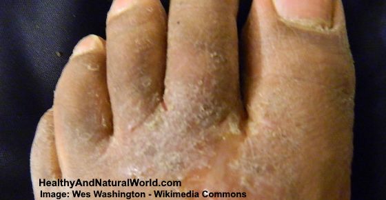 dry flaky soles of feet