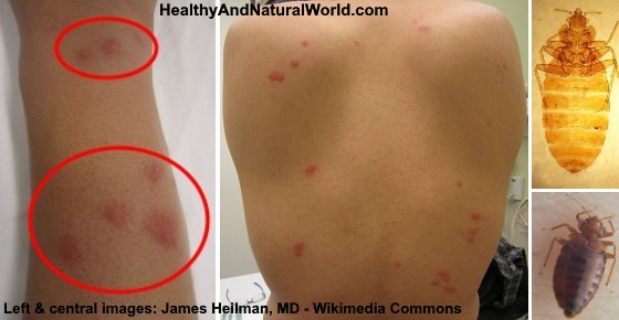 Bed Bug Rash: Symptoms and Natural Treatments for a Quick Relief
