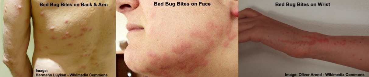 pictures of bed bug bites