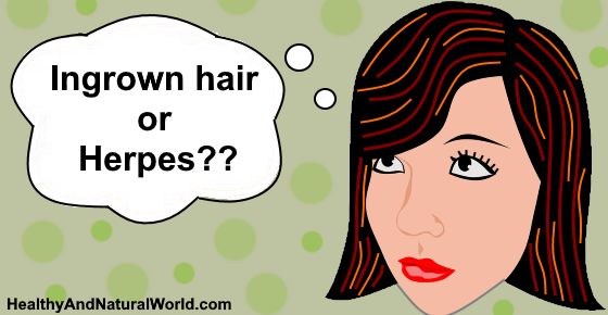 Ingrown Hair/Razor Bump Vs. Herpes or Genital Warts