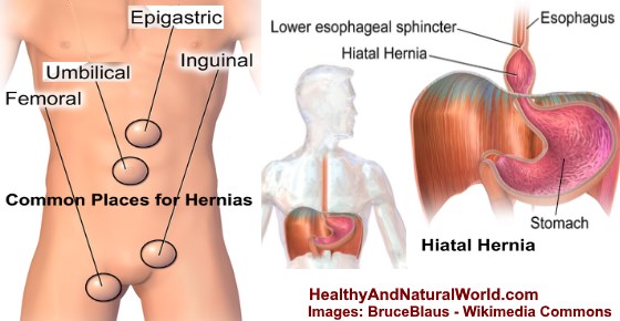 Pulled Abdominal Muscles vs. Hernia