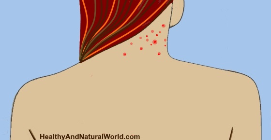 Pimples on Neck: How to Treat Neck Acne