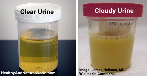 Cloudy Urine: What Does It Mean and Is It a Reason for Concern?