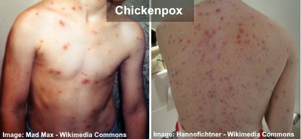 chickenpox