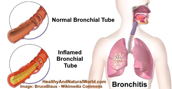 Bronchitis: Is It Contagious, Causes, Symptoms, and Transmission