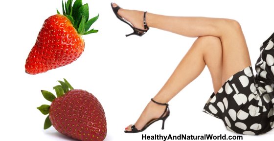 Strawberry Legs: Causes and How to Get Rid of Them with Home Remedies