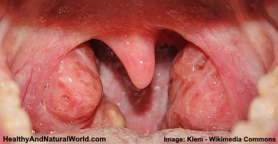 Red Bumps or Spots on Back of Throat: