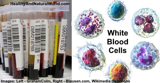 Elevated White Blood Cell (WBC) Count: Causes, Treatments and More