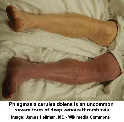 Picture of DVT in leg 