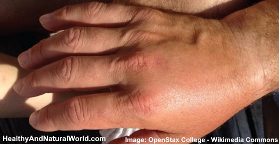 Swollen Fingers or Sausage Fingers (Dactylitis)