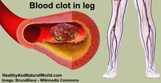 DVT in leg