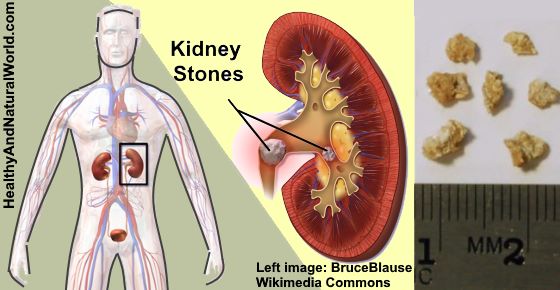 Kidney Stones: Early Signs and Symptoms