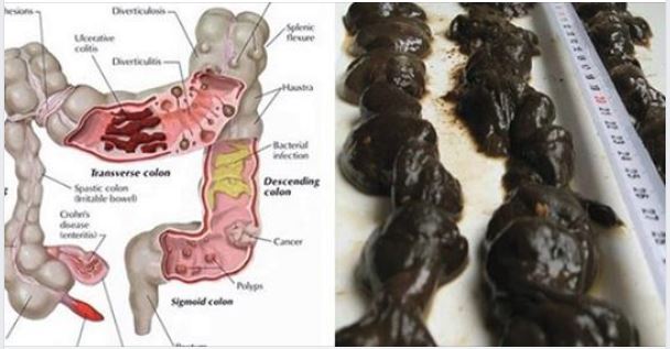 15-Day Colon Cleanse Detox – Herbal Laxative With Senna, Cascara Sagrada & Aloe Vera