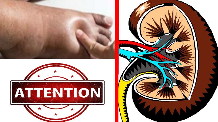 Early Signs of Kidney Disease & How to Protect Your Kidneys